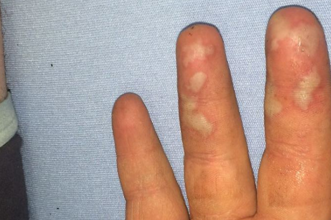 Apple-iPhone-catches-fire-burns-teenager (1)